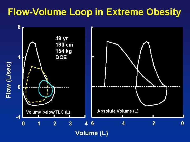 Flow-Volume Loop in Extreme Obesity 49 yr 163 cm 154 kg DOE Flow (L/sec)