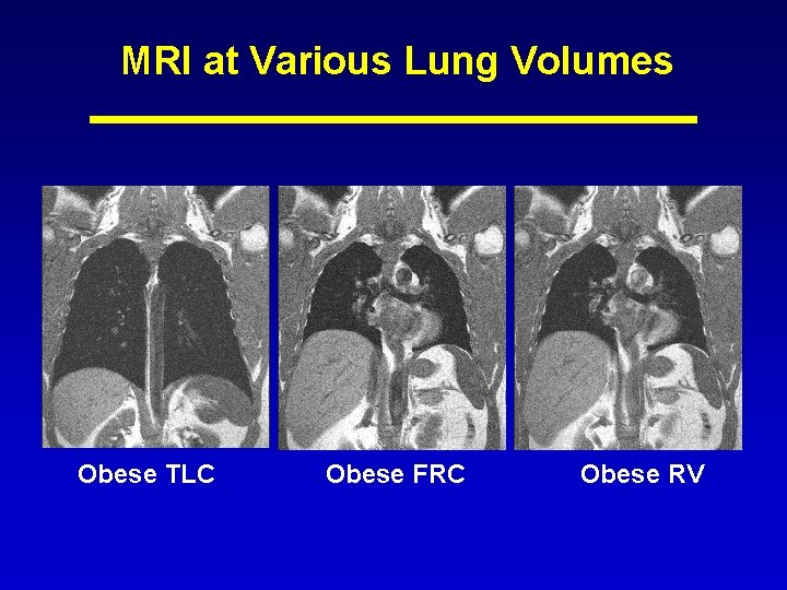 MRI at Various Lung Volumes Obese TLC Obese FRC Obese RV 