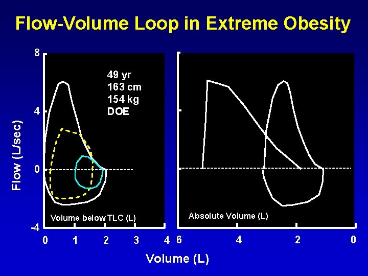 Flow-Volume Loop in Extreme Obesity 49 yr 163 cm 154 kg DOE Flow (L/sec)