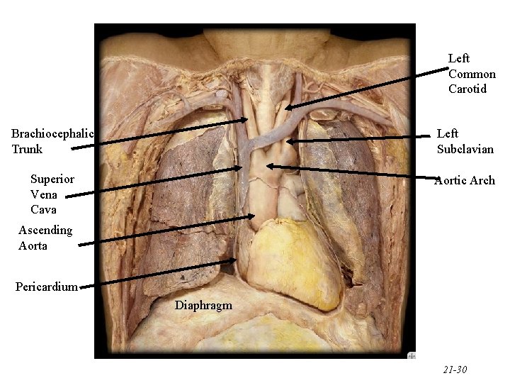 Left Common Carotid Brachiocephalic Trunk Left Subclavian Superior Vena Cava Aortic Arch Ascending Aorta