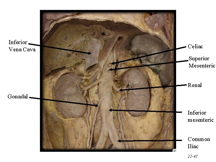 Inferior Vena Cava Celiac Superior Mesenteric Renal Gonadal Inferior mesenteric Common Iliac 21 -43