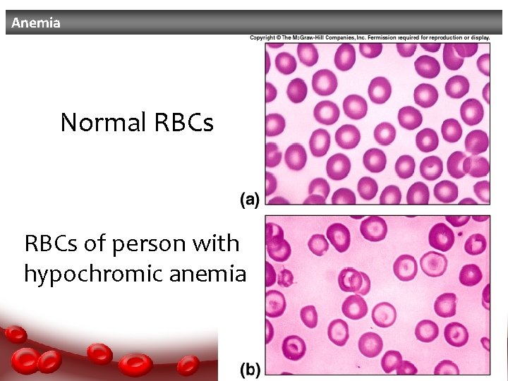 Anemia Normal RBCs of person with hypochromic anemia 13 