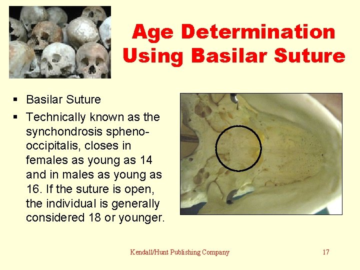 Age Determination Using Basilar Suture Technically known as the synchondrosis sphenooccipitalis, closes in females