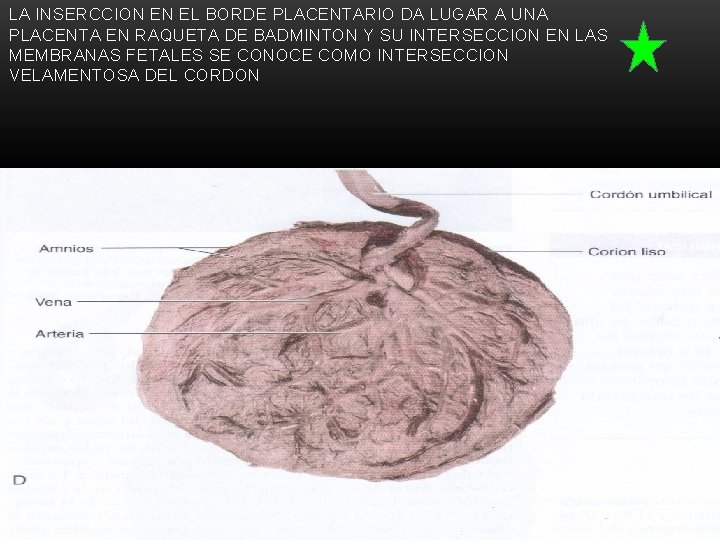 LA INSERCCION EN EL BORDE PLACENTARIO DA LUGAR A UNA PLACENTA EN RAQUETA DE