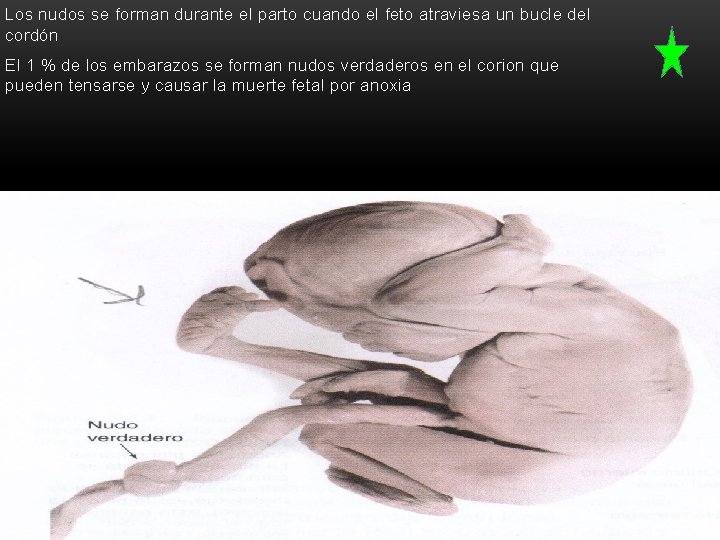 Los nudos se forman durante el parto cuando el feto atraviesa un bucle del