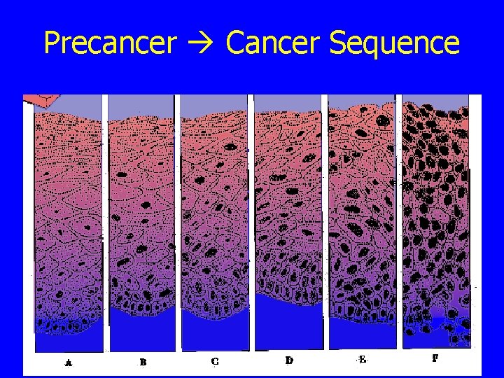 Precancer Cancer Sequence 