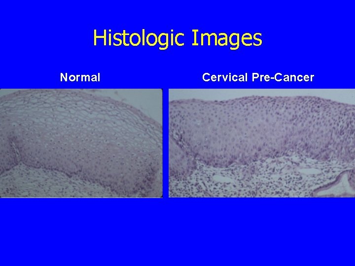 Histologic Images Normal Cervical Pre-Cancer 