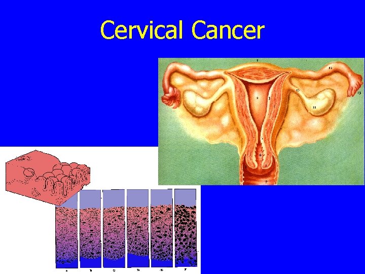 Cervical Cancer 