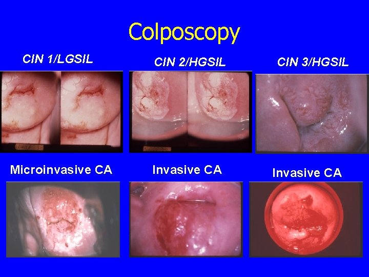 Colposcopy CIN 1/LGSIL CIN 2/HGSIL Microinvasive CA Invasive CA CIN 3/HGSIL Invasive CA 