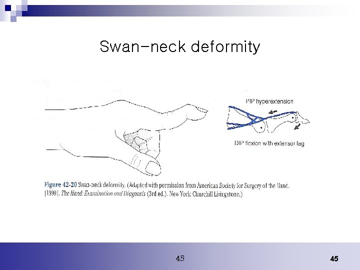 Swan-neck deformity 45 45 