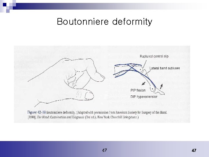 Boutonniere deformity 47 47 