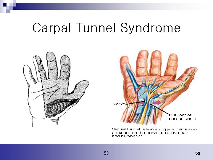 Carpal Tunnel Syndrome 50 50 