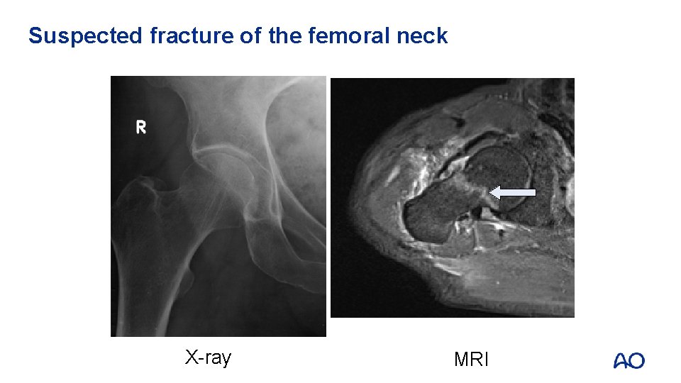 Suspected fracture of the femoral neck X-ray MRI 
