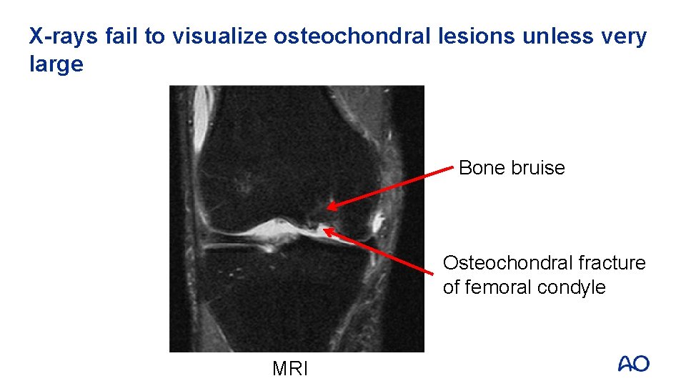 X-rays fail to visualize osteochondral lesions unless very large Bone bruise Osteochondral fracture of