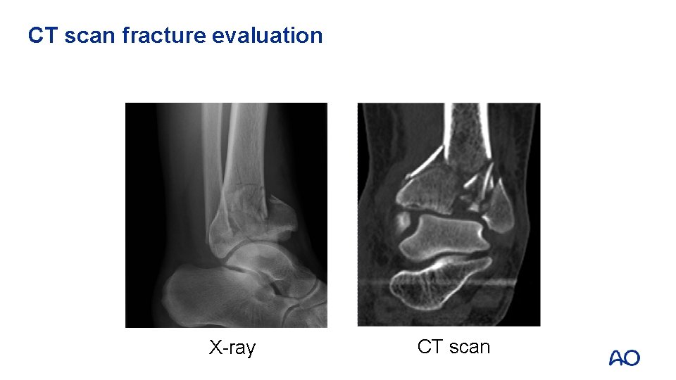 CT scan fracture evaluation X-ray CT scan 