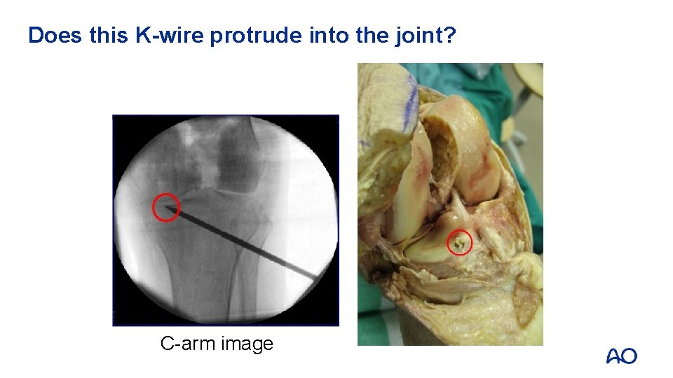 Does this K-wire protrude into the joint? C-arm image 
