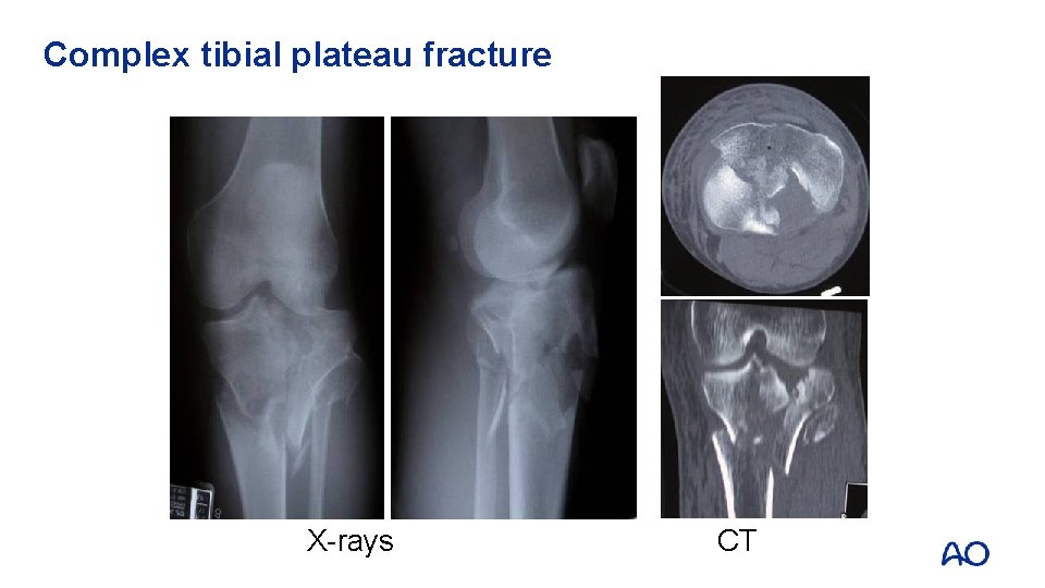 Complex tibial plateau fracture X-rays CT 