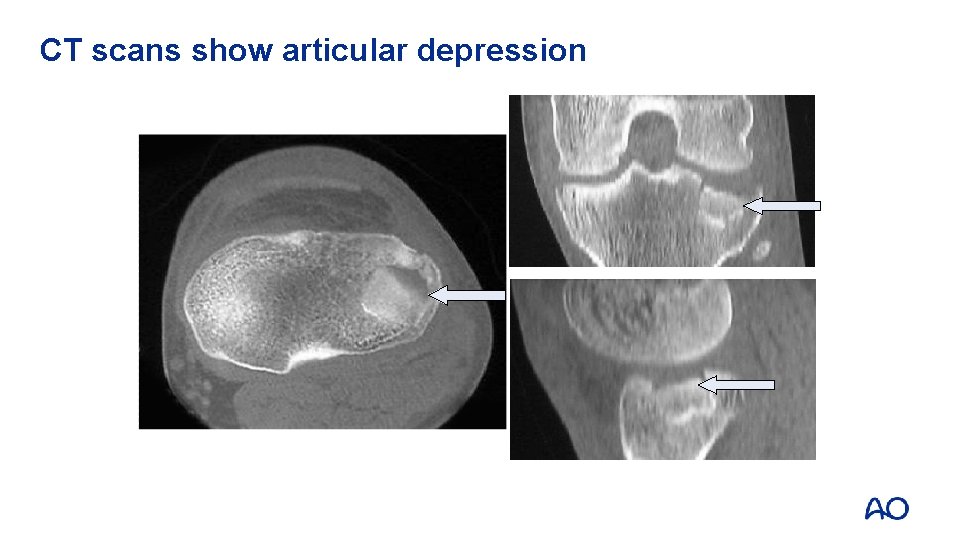 CT scans show articular depression 