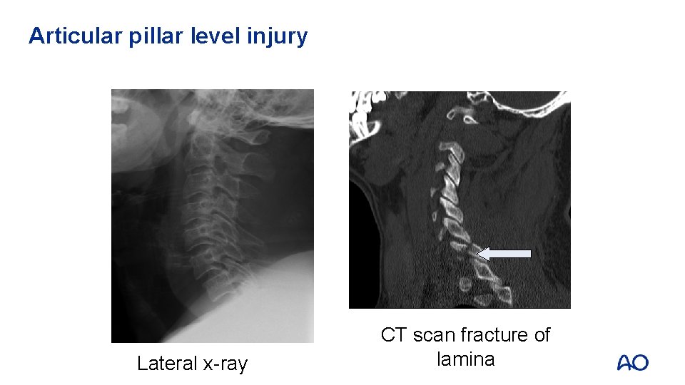 Articular pillar level injury Lateral x-ray CT scan fracture of lamina 