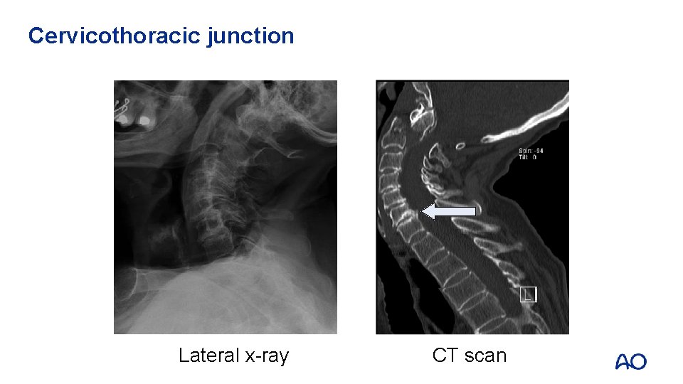 Cervicothoracic junction Lateral x-ray CT scan 