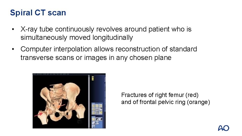 Spiral CT scan • X-ray tube continuously revolves around patient who is simultaneously moved