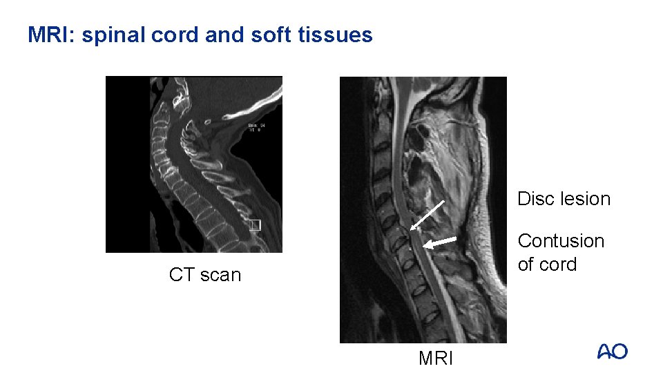 MRI: spinal cord and soft tissues Disc lesion Contusion of cord CT scan MRI