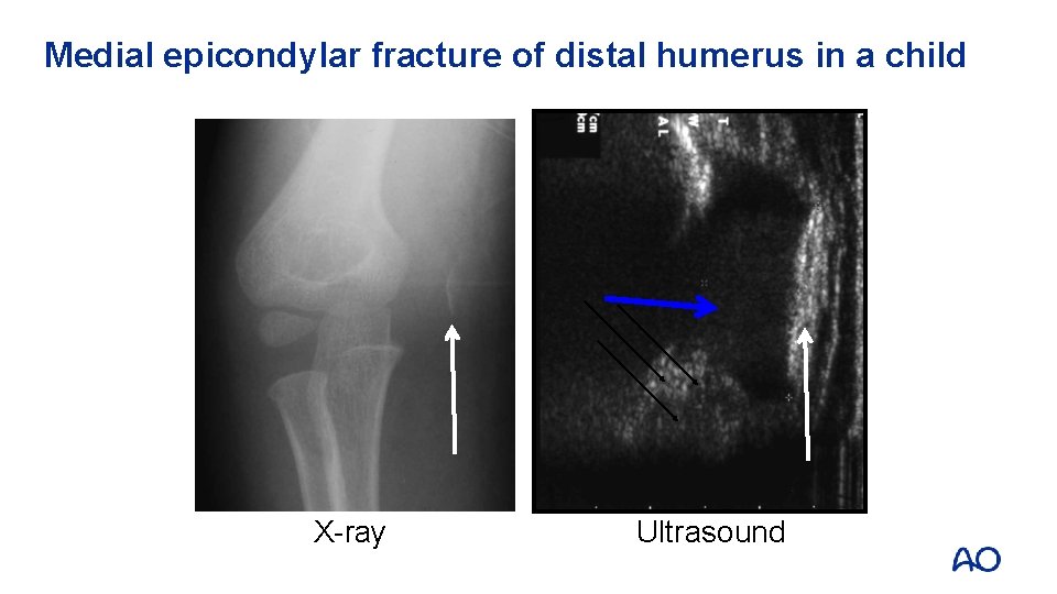 Medial epicondylar fracture of distal humerus in a child X-ray Ultrasound 