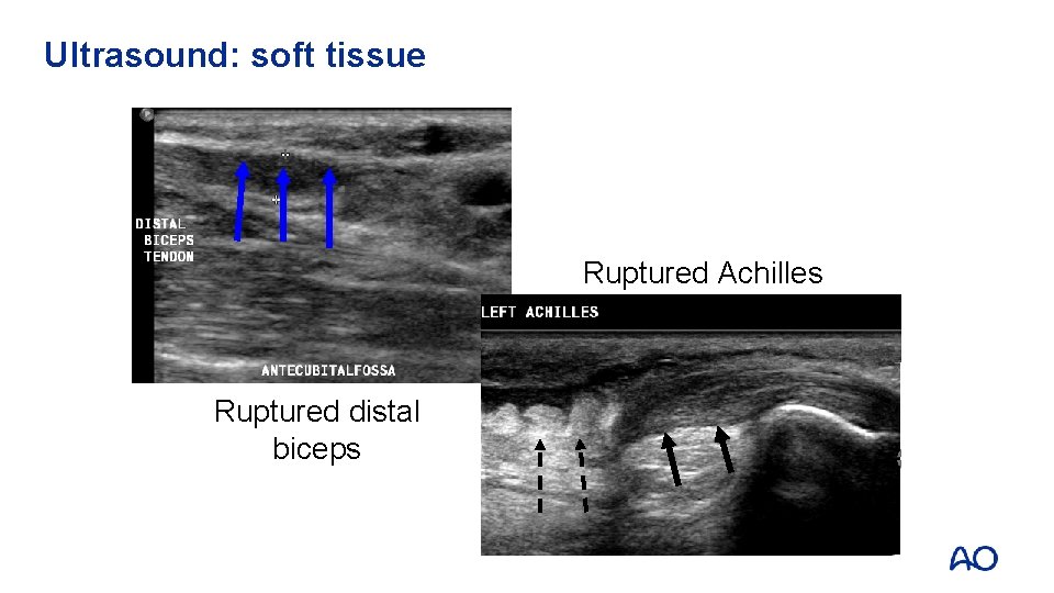 Ultrasound: soft tissue Ruptured Achilles tendon Ruptured distal biceps 