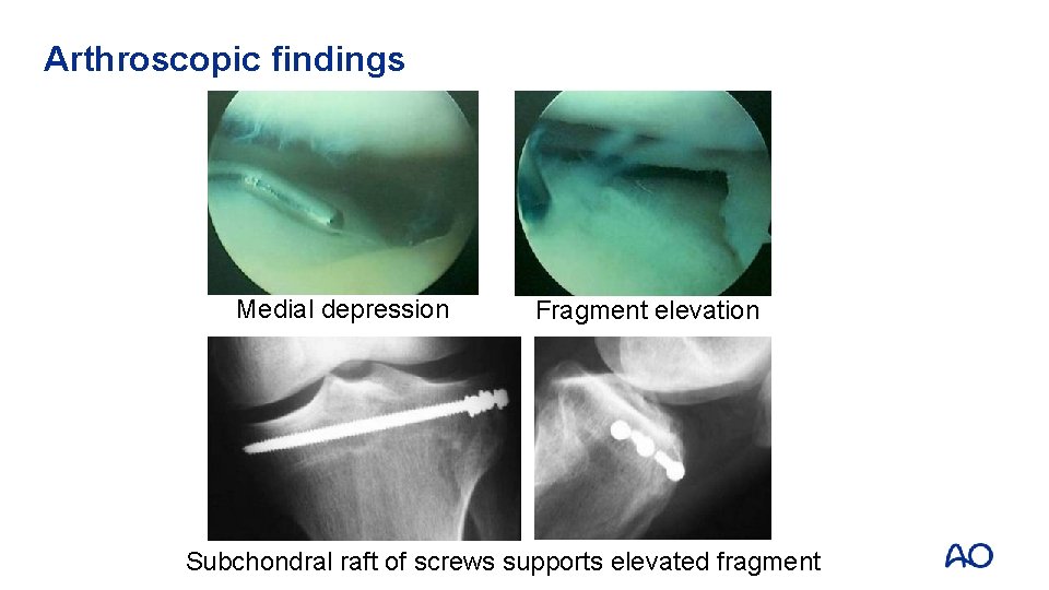 Arthroscopic findings Medial depression Fragment elevation Subchondral raft of screws supports elevated fragment 