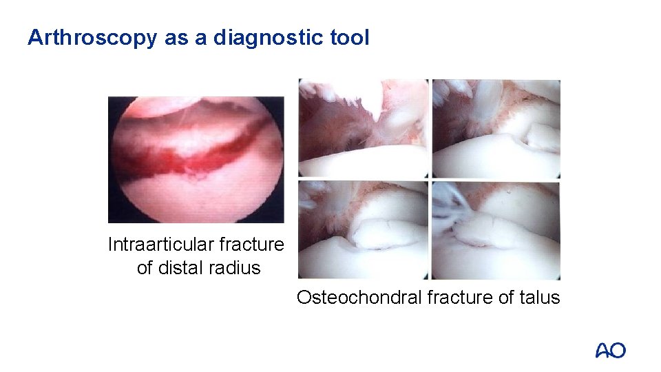 Arthroscopy as a diagnostic tool Intraarticular fracture of distal radius Osteochondral fracture of talus