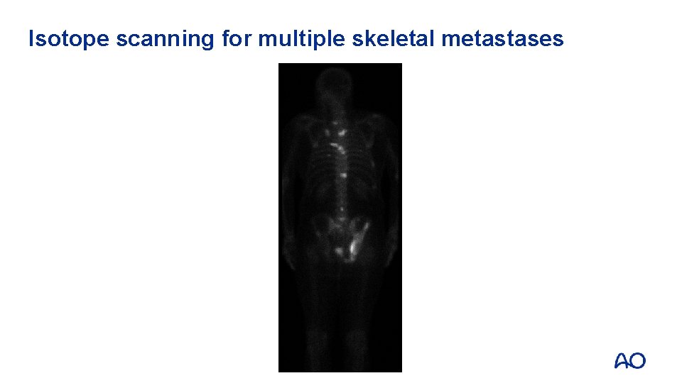 Isotope scanning for multiple skeletal metastases 