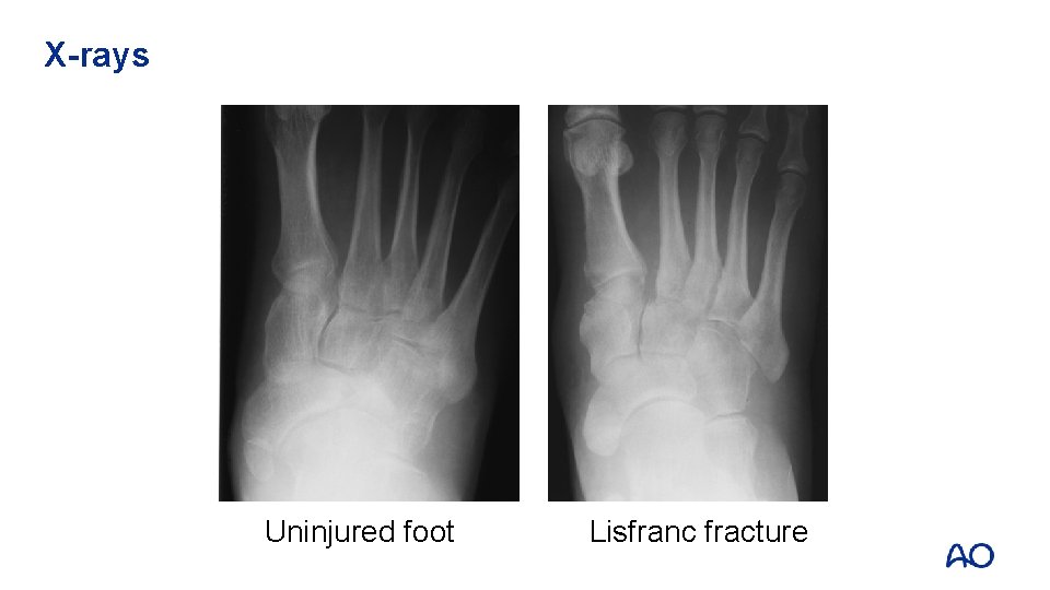 X-rays Uninjured foot Lisfranc fracture 