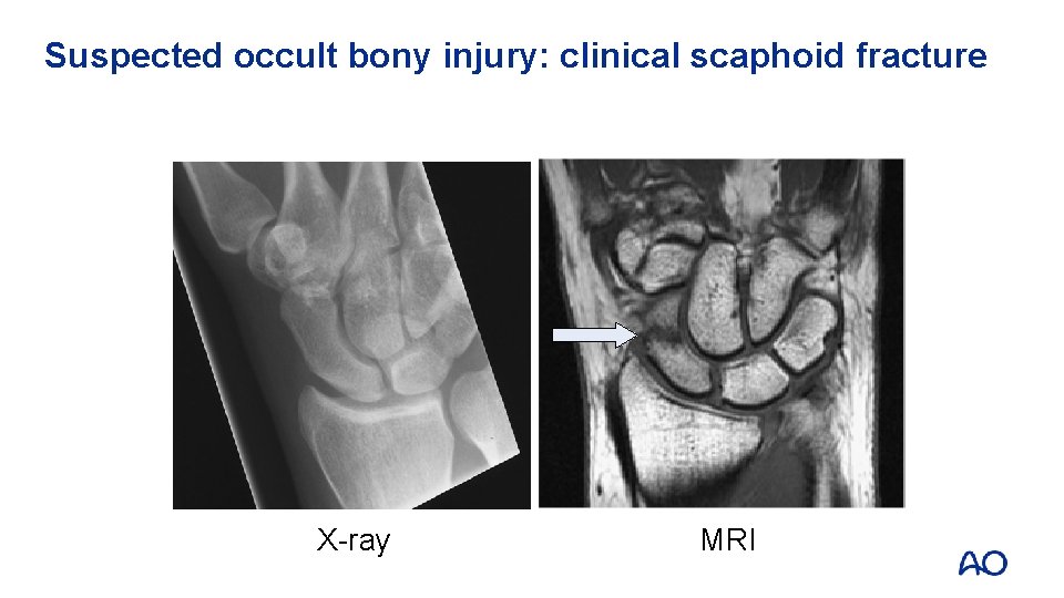 Suspected occult bony injury: clinical scaphoid fracture X-ray MRI 