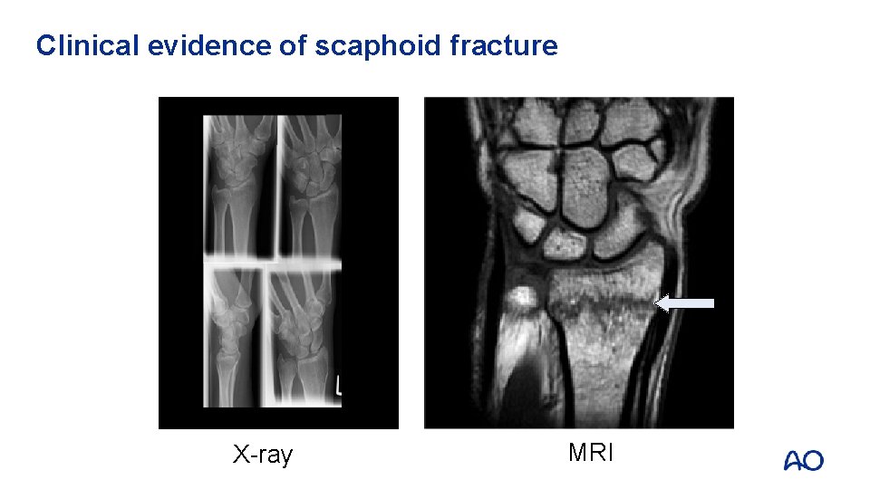 Clinical evidence of scaphoid fracture X-ray MRI 
