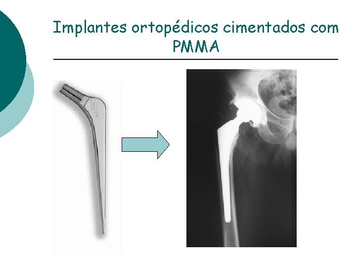 Implantes ortopédicos cimentados com PMMA 