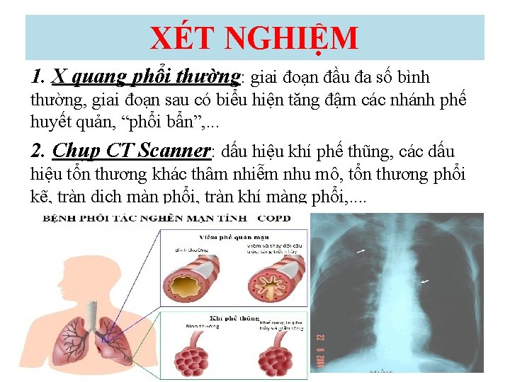 XÉT NGHIỆM 1. X quang phổi thường: giai đoạn đầu đa số bình thường,