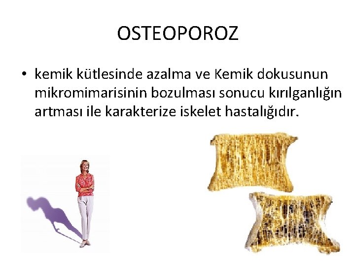 OSTEOPOROZ • kemik kütlesinde azalma ve Kemik dokusunun mikromimarisinin bozulması sonucu kırılganlığın artması ile