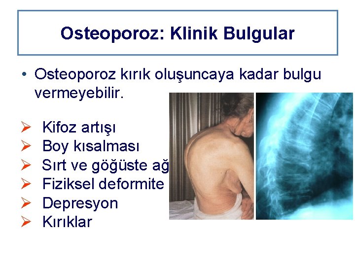 Osteoporoz: Klinik Bulgular • Osteoporoz kırık oluşuncaya kadar bulgu vermeyebilir. Ø Ø Ø Kifoz