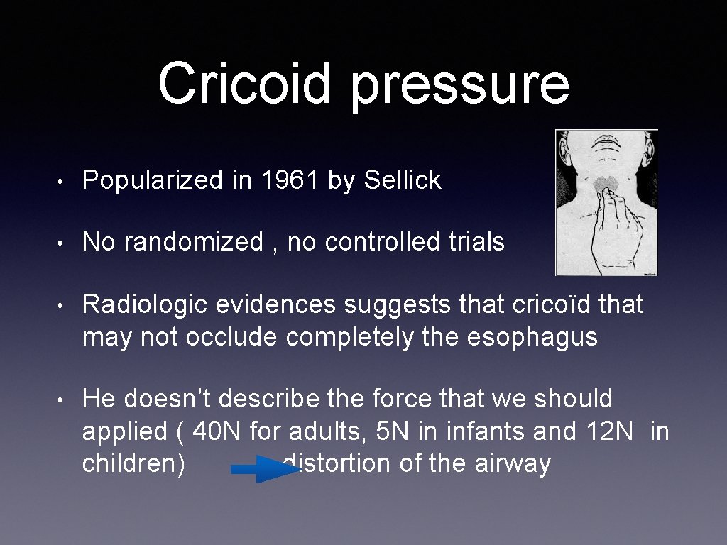 Cricoid pressure • Popularized in 1961 by Sellick • No randomized , no controlled