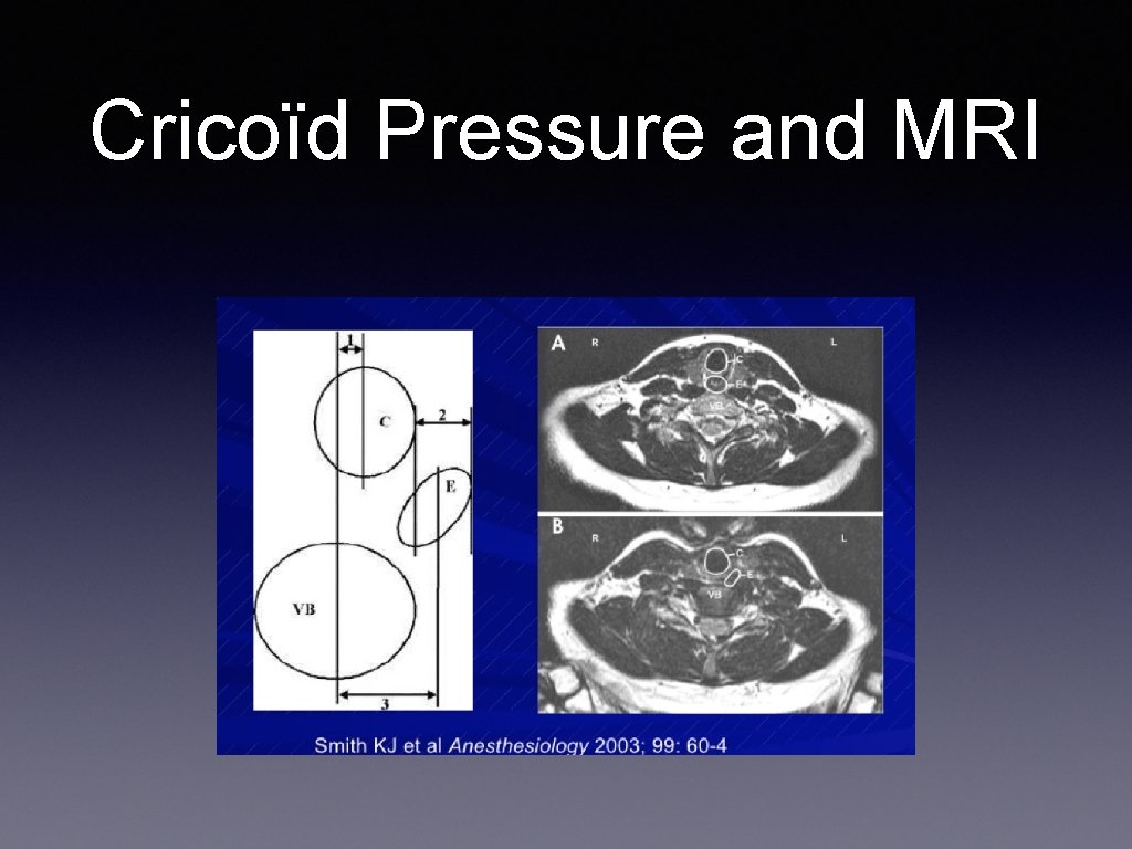 Cricoïd Pressure and MRI 