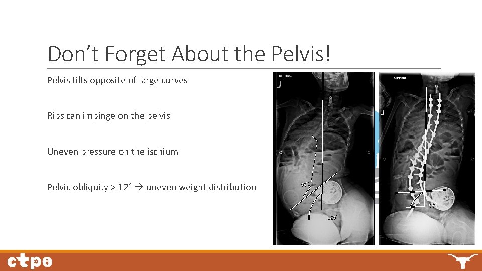 Don’t Forget About the Pelvis! Pelvis tilts opposite of large curves Ribs can impinge