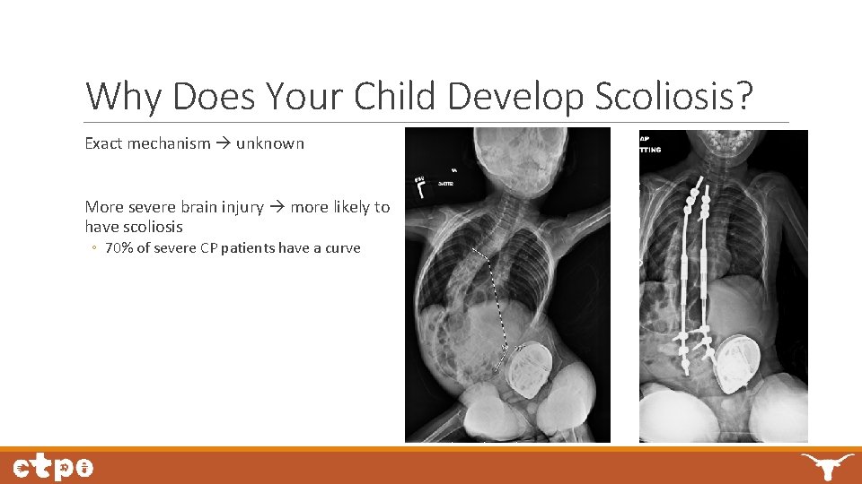 Why Does Your Child Develop Scoliosis? Exact mechanism unknown More severe brain injury more