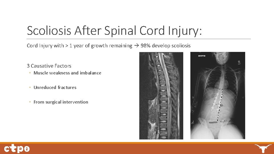 Scoliosis After Spinal Cord Injury: Cord Injury with > 1 year of growth remaining