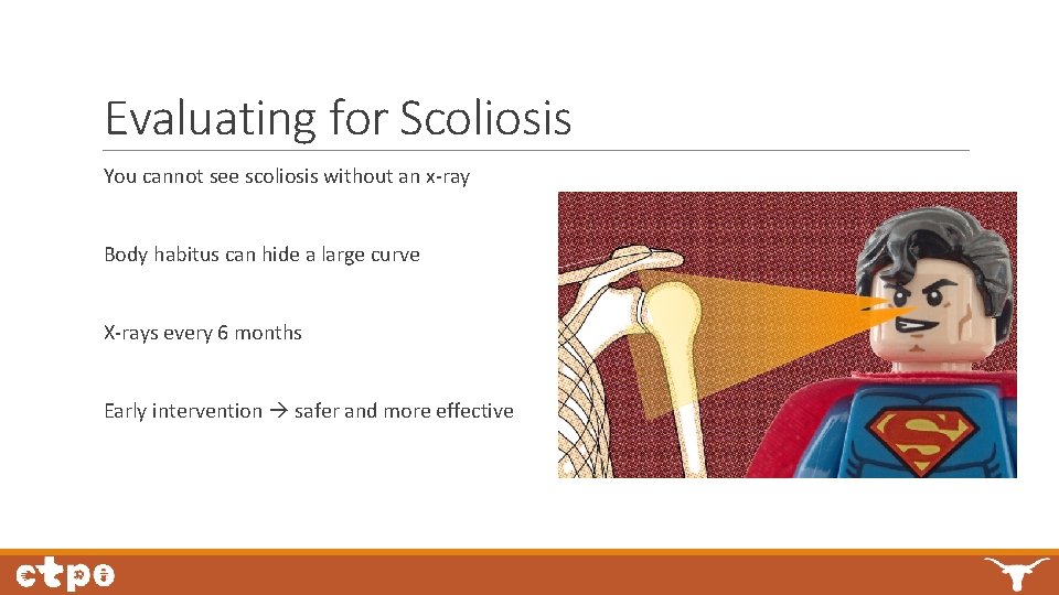 Evaluating for Scoliosis You cannot see scoliosis without an x-ray Body habitus can hide