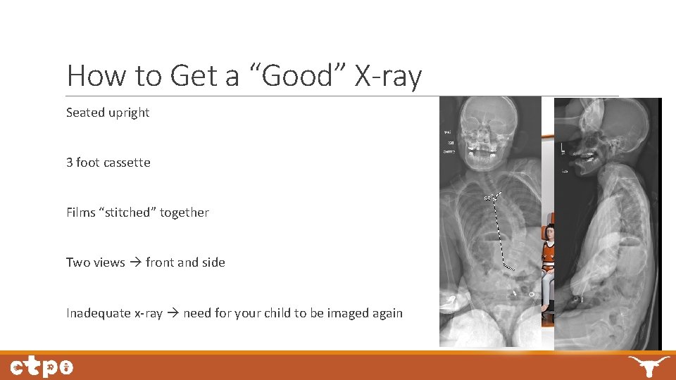 How to Get a “Good” X-ray Seated upright 3 foot cassette Films “stitched” together