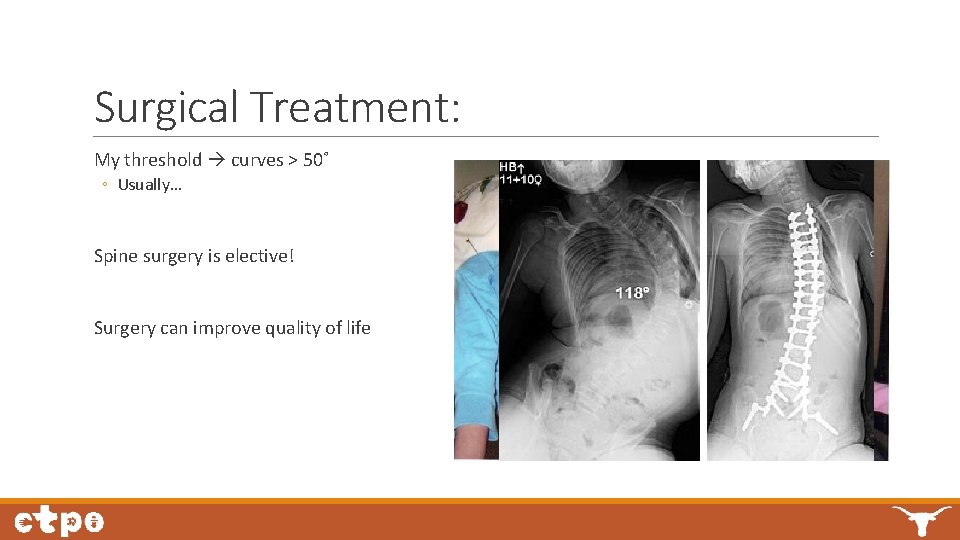 Surgical Treatment: My threshold curves > 50˚ ◦ Usually… Spine surgery is elective! Surgery