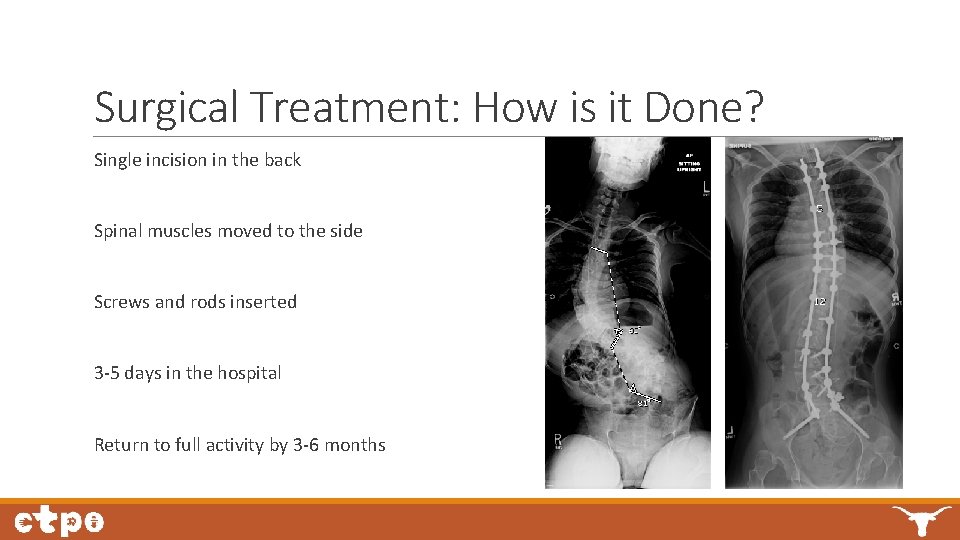 Surgical Treatment: How is it Done? Single incision in the back Spinal muscles moved