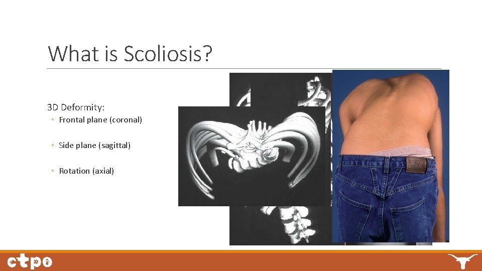 What is Scoliosis? 3 D Deformity: ◦ Frontal plane (coronal) ◦ Side plane (sagittal)