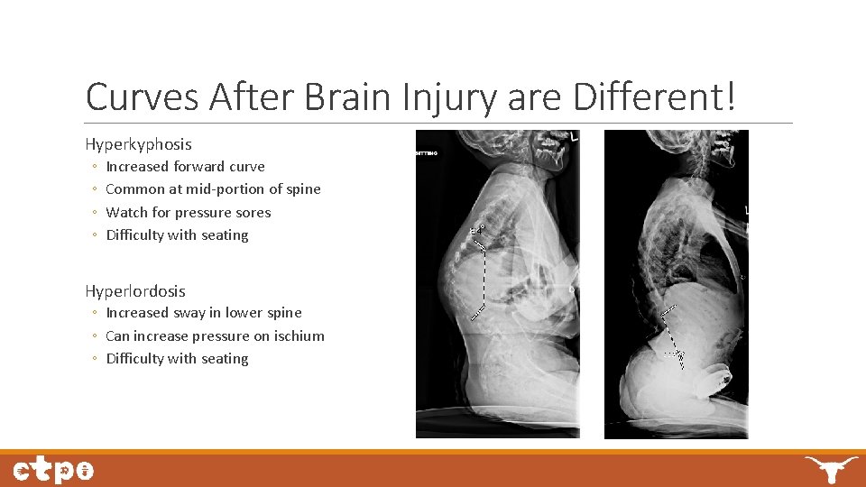 Curves After Brain Injury are Different! Hyperkyphosis ◦ ◦ Increased forward curve Common at