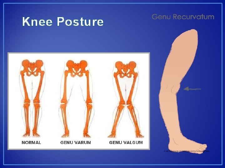 Knee Posture 